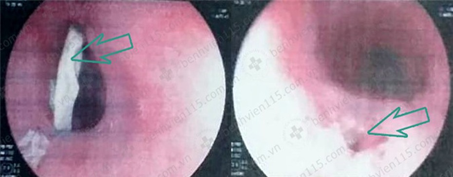 Suýt mất mạng trong năm mới 2019 chỉ vì xương gà