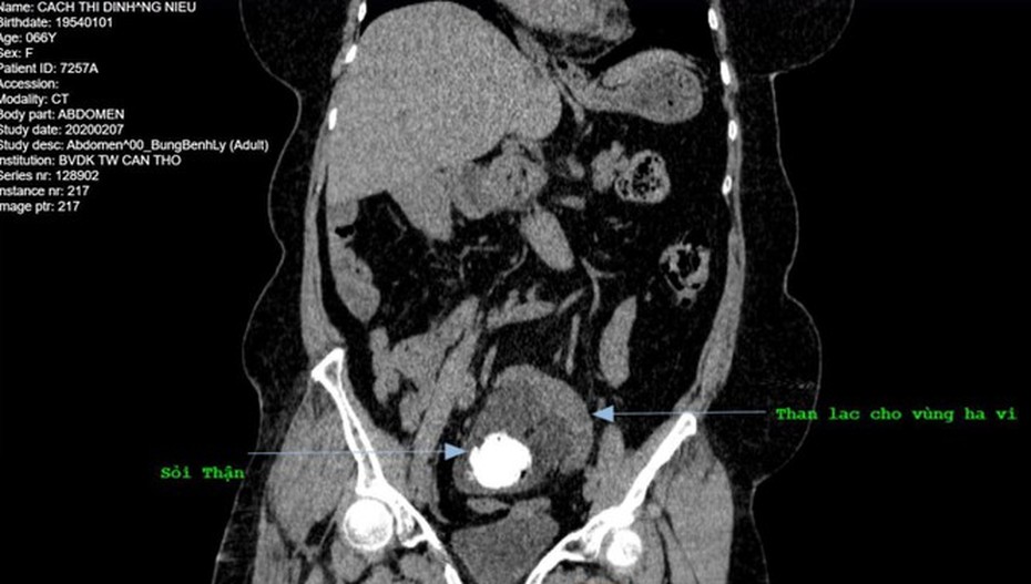 Hy hữu: Người phụ nữ có thận lạc chỗ vào hố chậu hiếm gặp được phẫu thuật thành công