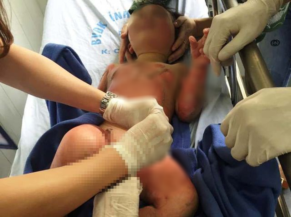 Cô giáo đốt cồn dạy phòng chống cháy nổ, 3 trẻ mầm non bị bỏng