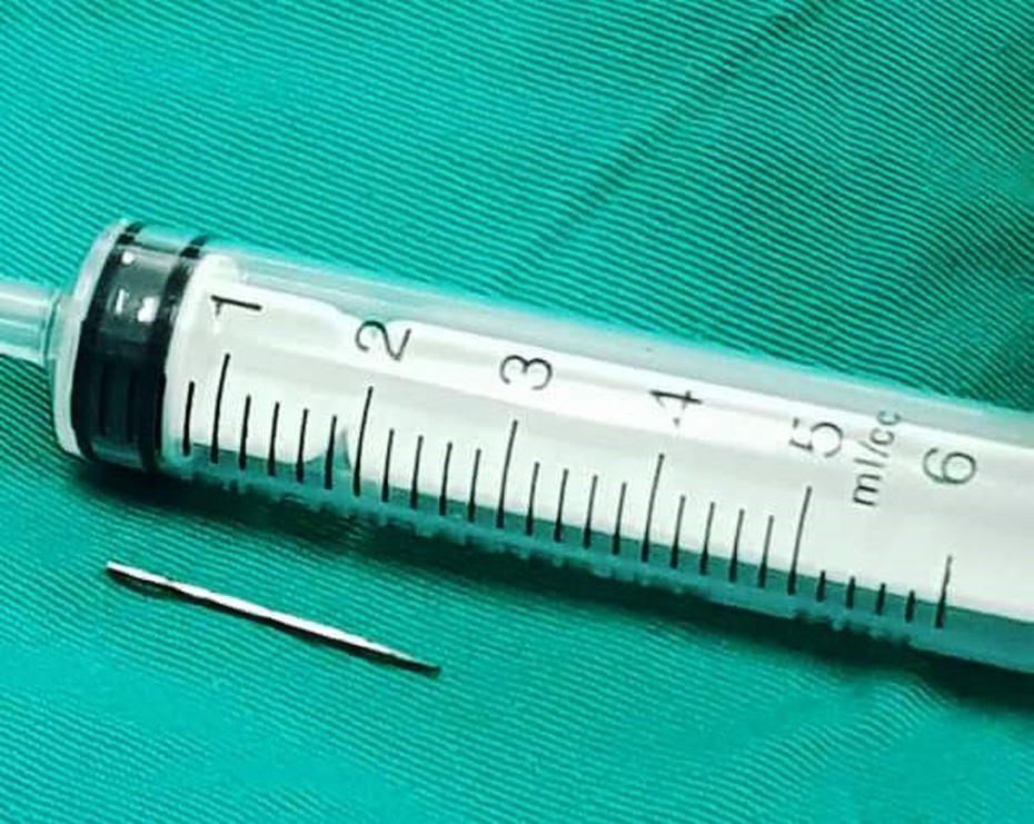 Mổ lấy kim khâu dài 2cm nằm trong khuỷu tay bé 12 tuổi