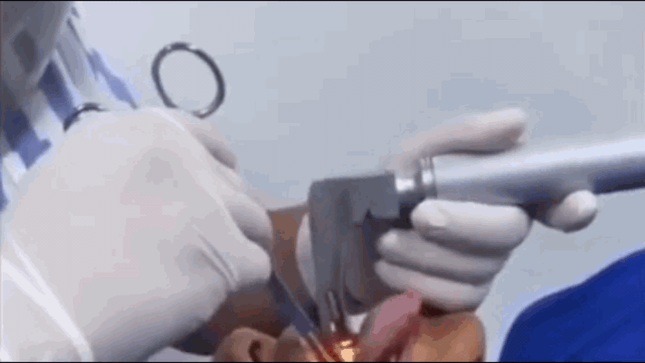 Clip: Gắp con cá sống dài 18cm ra khỏi cổ họng nam thanh niên