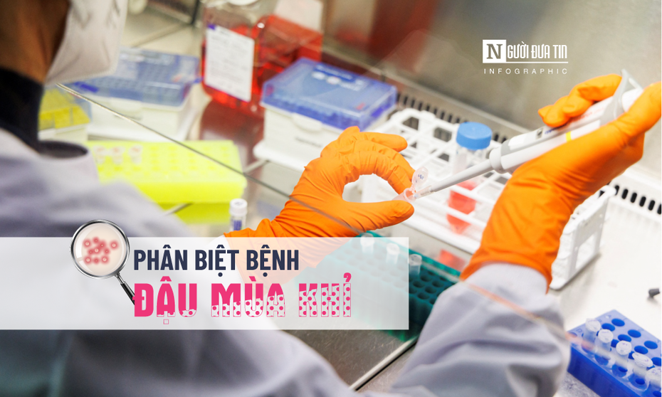 Info: Phân biệt bệnh đậu mùa khỉ với thủy đậu, tay chân miệng