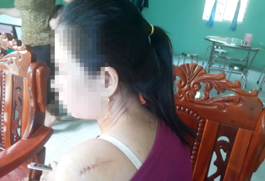 Sức khỏe các nạn nhân trong vụ cô dâu bị chồng cũ chém trong ngày cưới giờ ra sao?