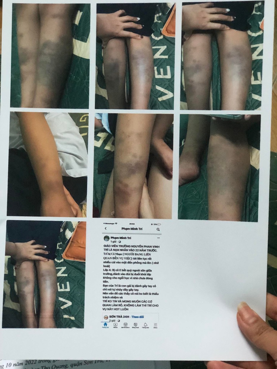 Vụ học sinh lớp 1 bị đánh bầm tím: Tiết lộ lời kể của cháu bé với mẹ?