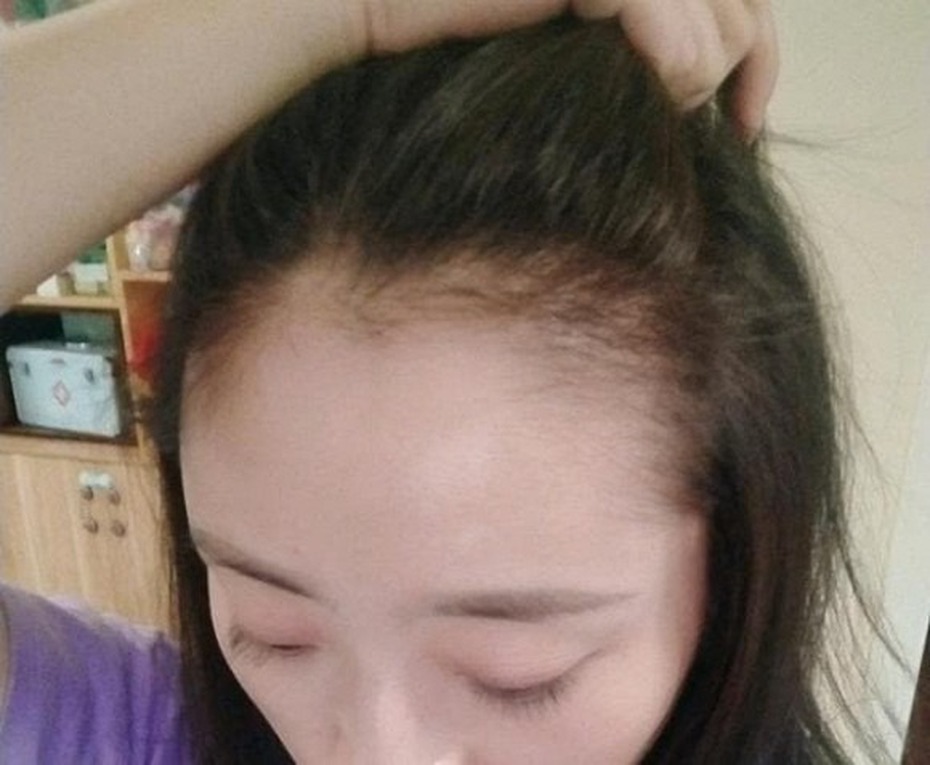 Cô gái mắc bệnh trọng vì rụng tóc quá nhiều