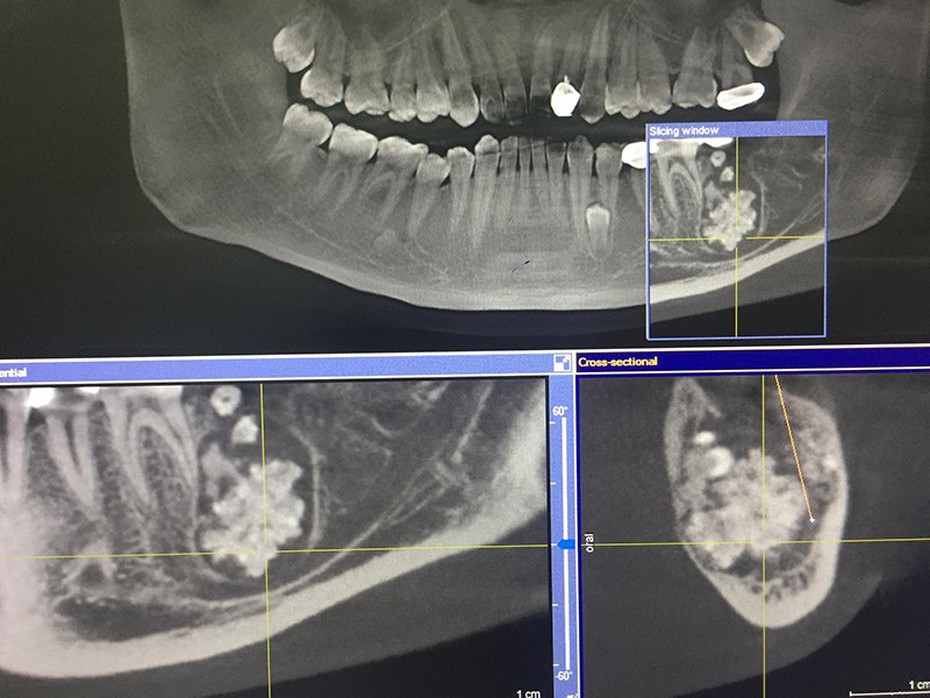 Nam thanh niên ở Hà Nội có khối u lạ chứa nhiều răng nhỏ trong miệng