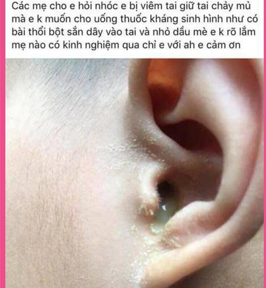 Thực hư thổi bột sắn dây và nhỏ dầu mè chữa dứt điểm viêm tai giữa?