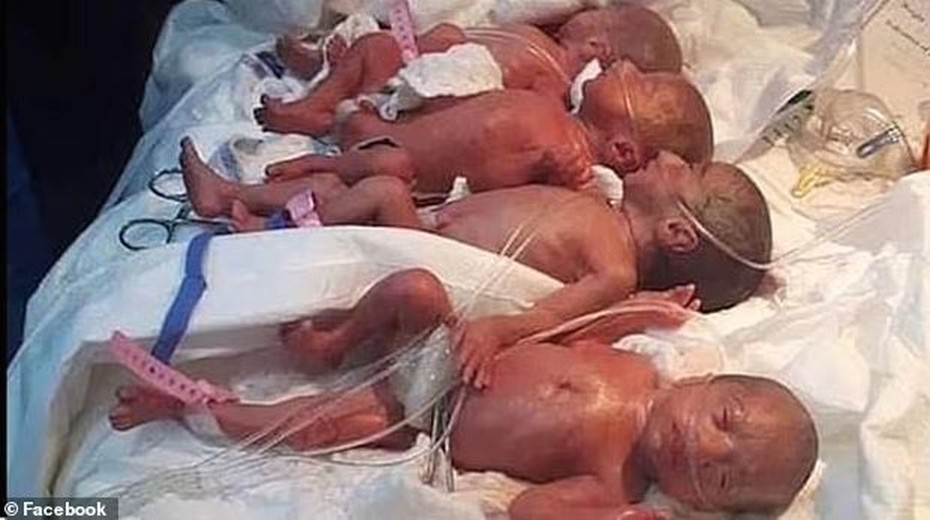 Bà mẹ trẻ 1 lần sinh 9 khiến các bác sĩ tròn mắt