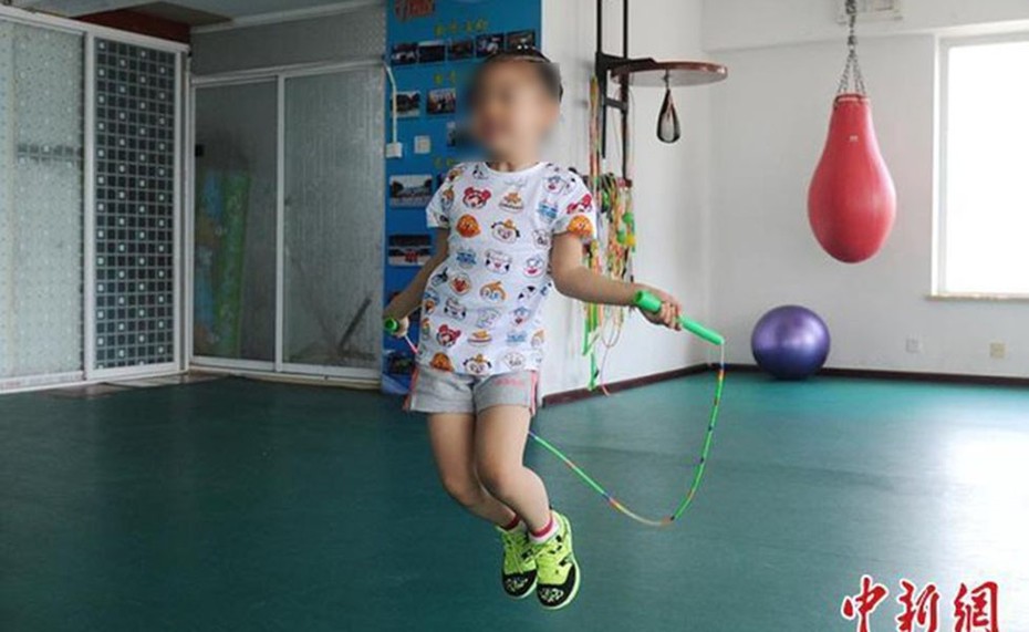Bị mẹ ép nhảy dây 3.000 cái/ngày, bé gái 13 tuổi suýt hỏng đầu gối