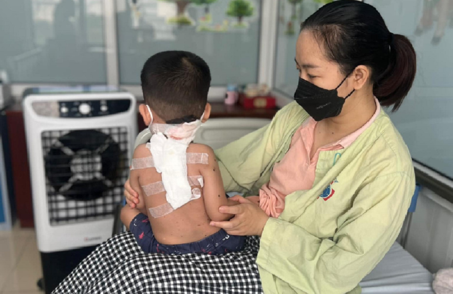 Mắc bệnh hiếm gặp, 2 trẻ có mảng bớt đen khổng lồ trên lưng