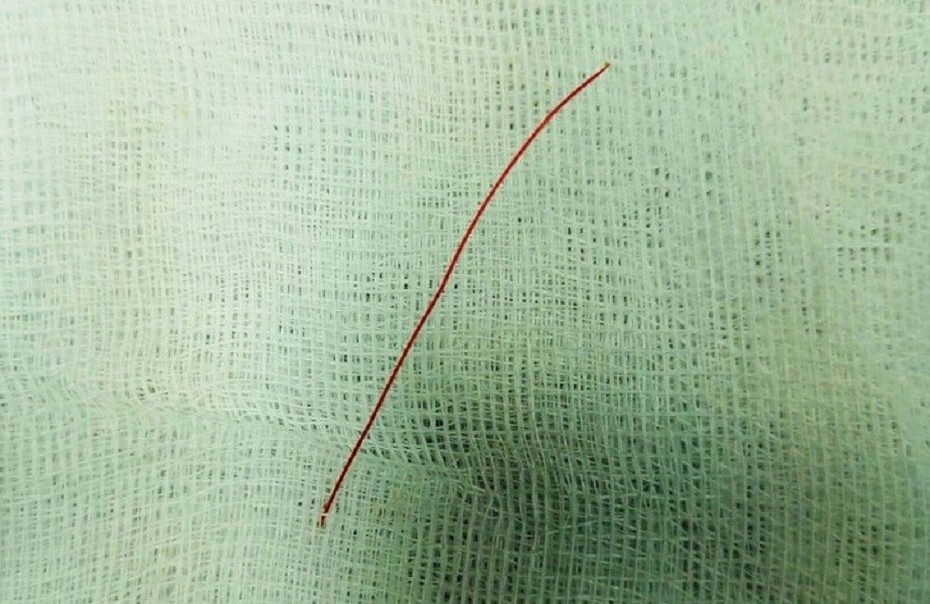 Đoạn cước dài 5cm đâm thủng ruột cháu bé 7 tuổi
