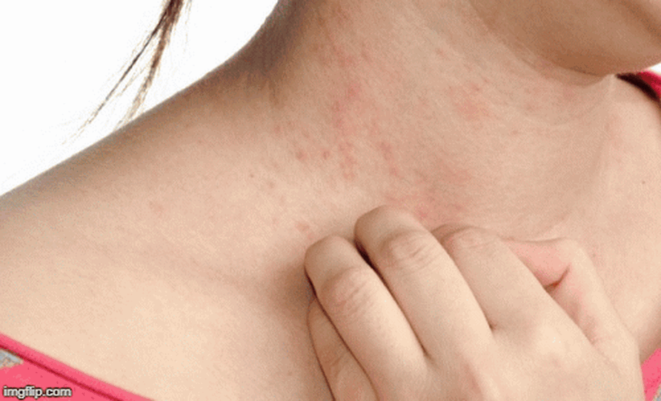 Bệnh lạ: Ngất thậm chí tử vong khi chạm vào nước