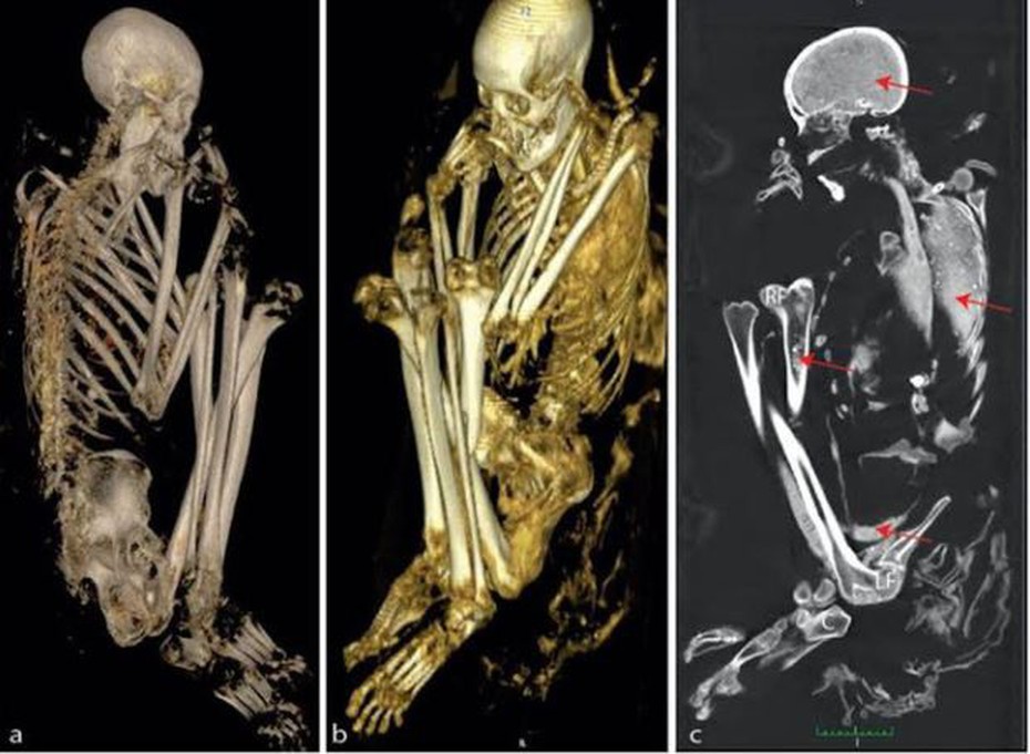 Hé lộ sự thật về xác ướp quái dị được ghép từ 6 thi thể người