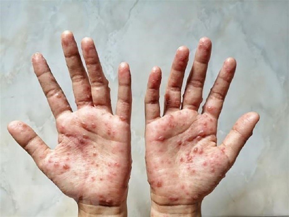 Bệnh đậu mùa khỉ là trường hợp khẩn cấp, Việt Nam có nguy cơ bị xâm nhập rất lớn