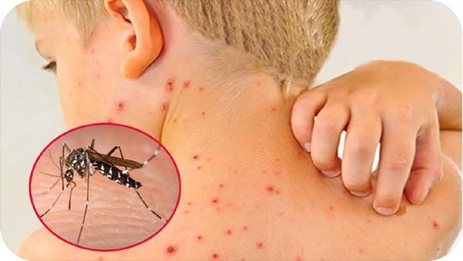 Chuyên gia chỉ ra những điều cần làm để phòng bệnh sốt xuất huyết