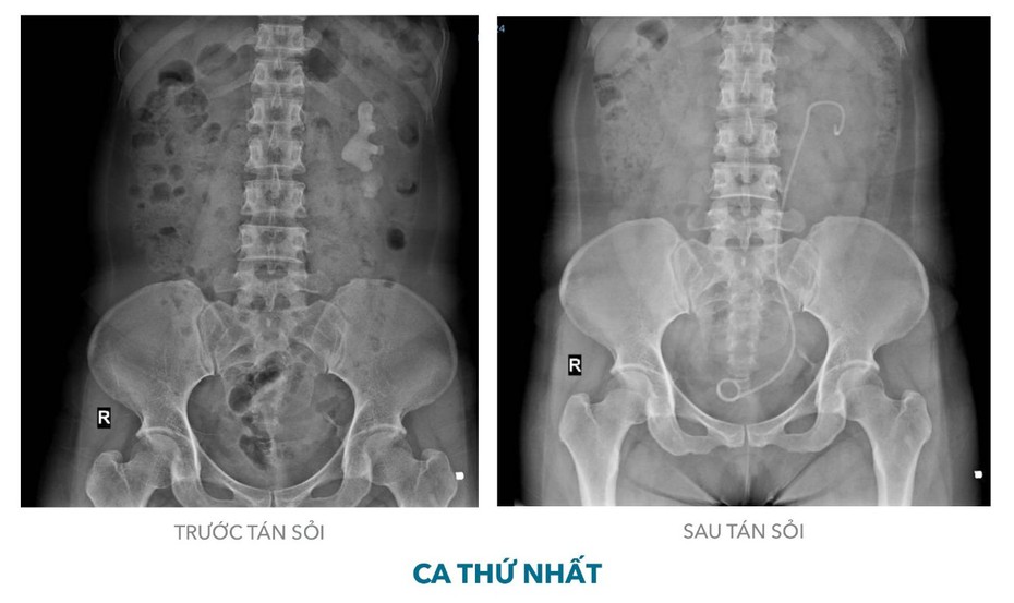 Khánh Hòa: Tán sỏi san hô qua da bằng đường hầm nhỏ cho 2 bệnh nhân