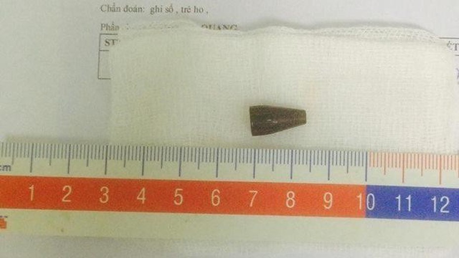 Gắp thành công đầu bút bi dài 1,4cm trong phế quản bé 8 tuổi