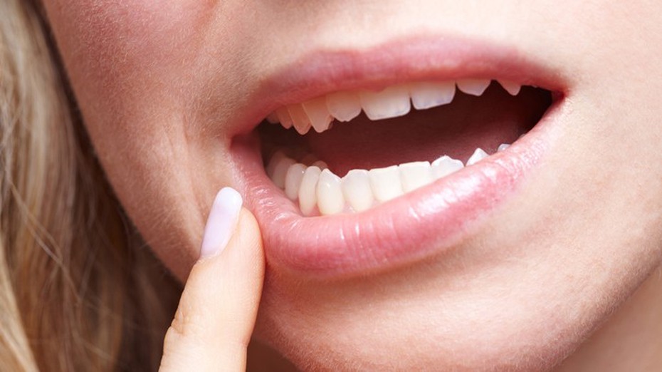 8 dấu hiệu đang tố bạn mắc ung thư miệng
