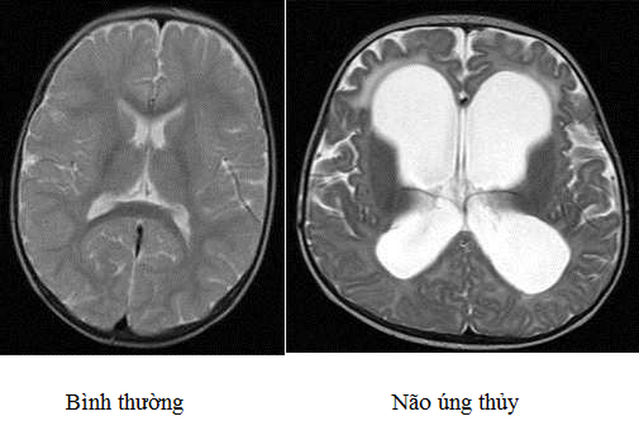 Bé trai bị não úng thủy to như quả bóng tử vong