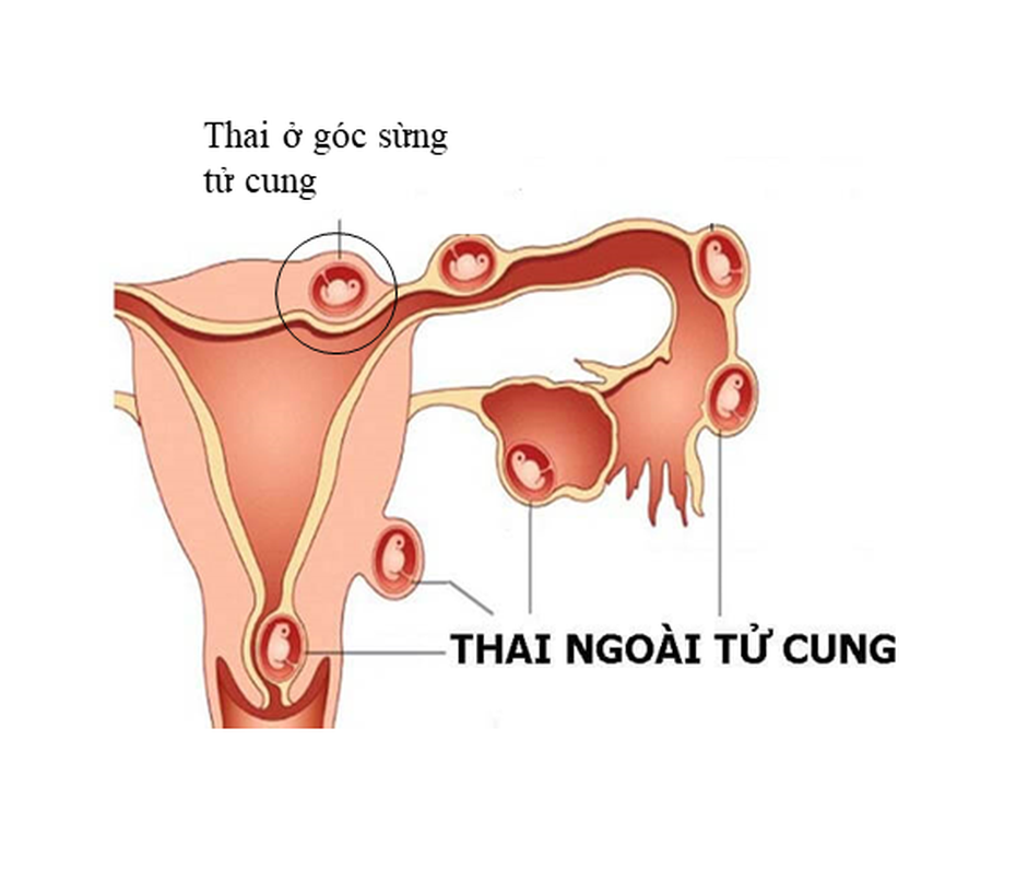 Cứu sống thai phụ vỡ song thai ngoài tử cung hiếm gặp