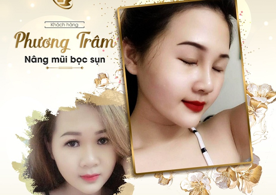 Ngẩn ngơ trước vẻ đẹp của những cô nàng sau nâng mũi bọc sụn