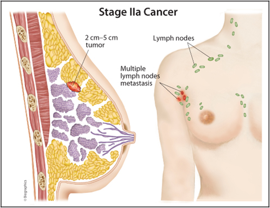 Ung thư vú giai đoạn 2: Đặc điểm và dấu hiệu nhận biết bệnh