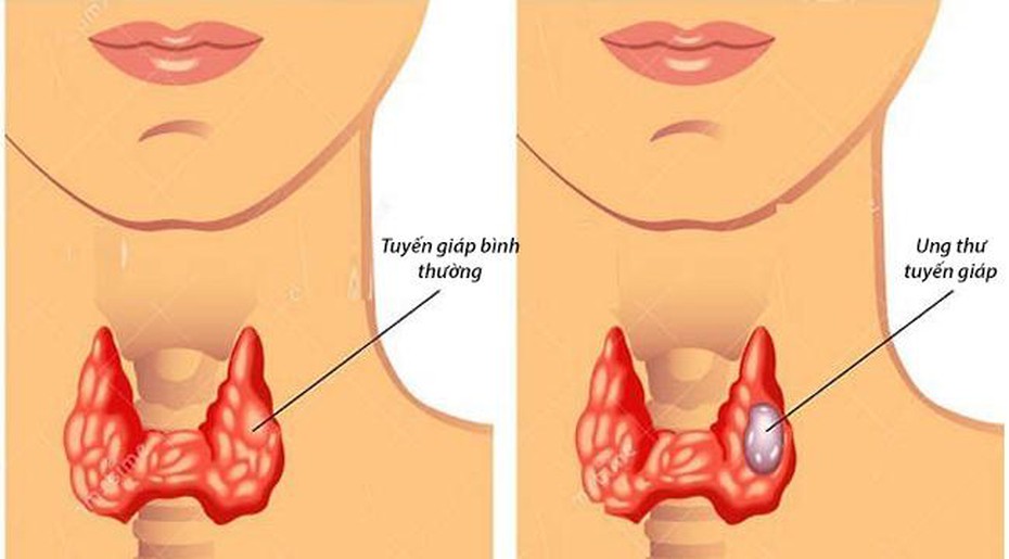 Thấy các dấu hiệu này của bệnh ung thư tuyến giáp bạn cần đi gặp bác sỹ ngay