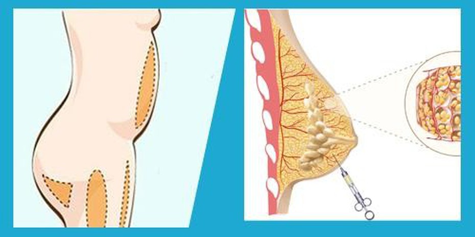 Bạn hiểu gì về công nghệ nâng ngực bằng mỡ tự thân?