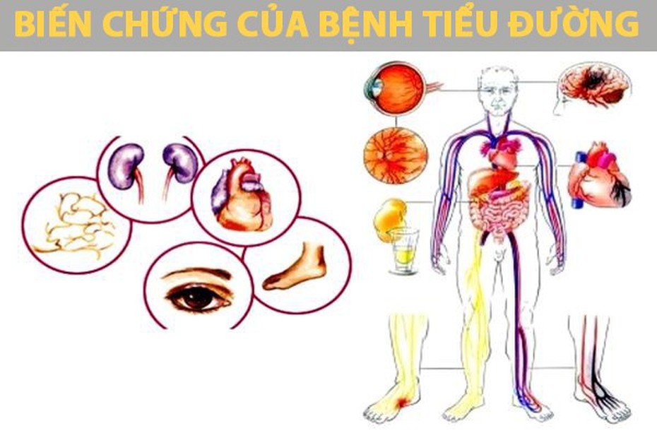 Các nguyên nhân gây bệnh tiểu đường thường gặp