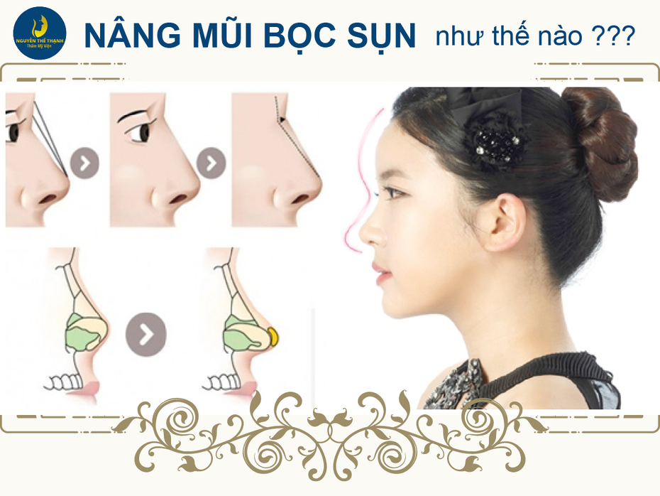 Nâng mũi bọc sụn là như thế nào?
