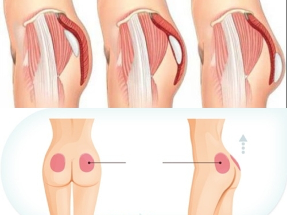 Nâng mông nội soi – Bí quyết cho mông căng tròn