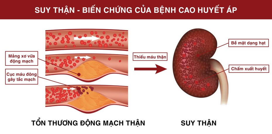 Tiểu đêm nhiều lần và huyết áp cao dễ gây suy thận