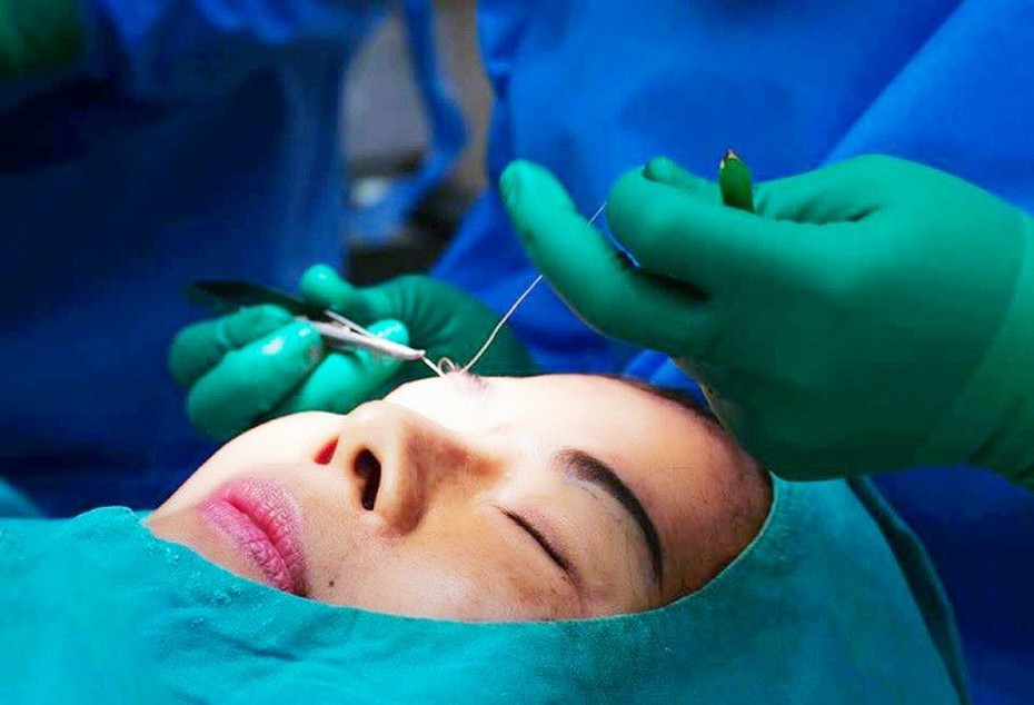 Theo chân khách hàng đến Viện thẩm mỹ D’vincy sửa mí hỏng