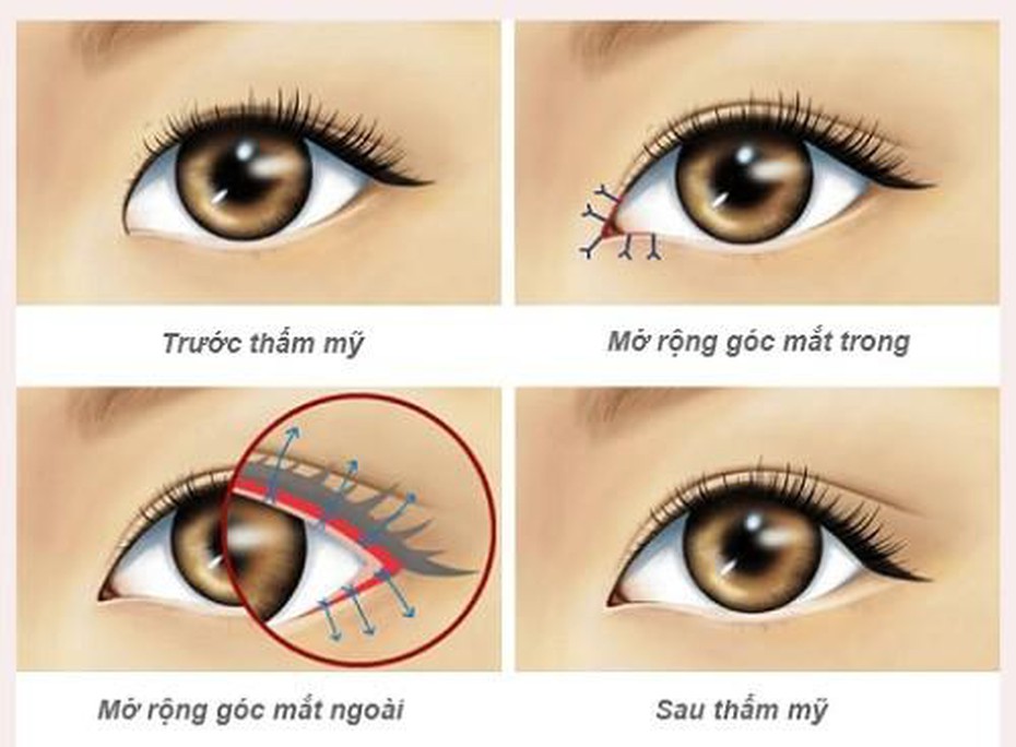 Mở rộng góc mắt có sẹo không?