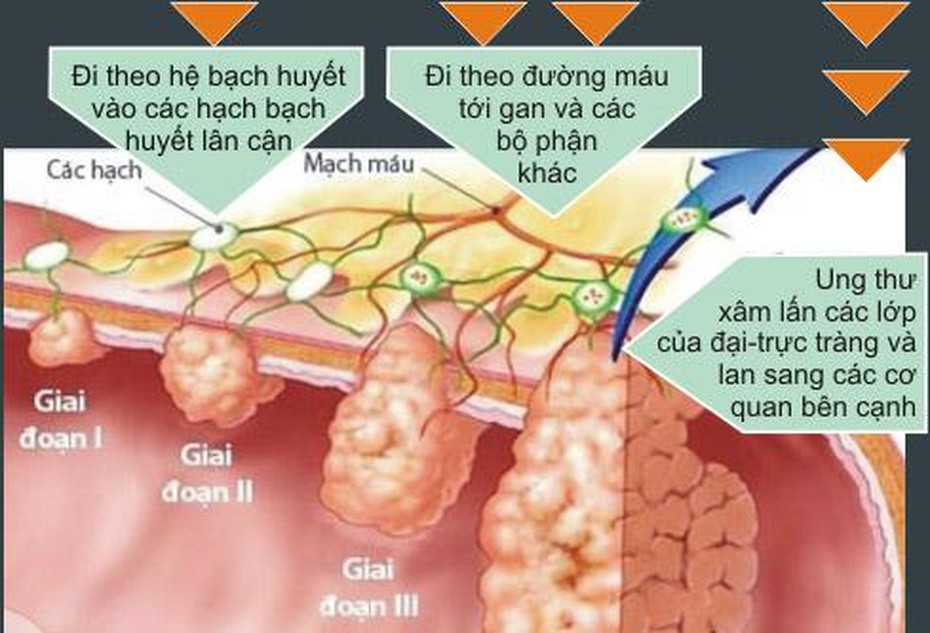 Nguy cơ mắc bệnh ung thư chỉ vì viêm đại tràng lâu năm