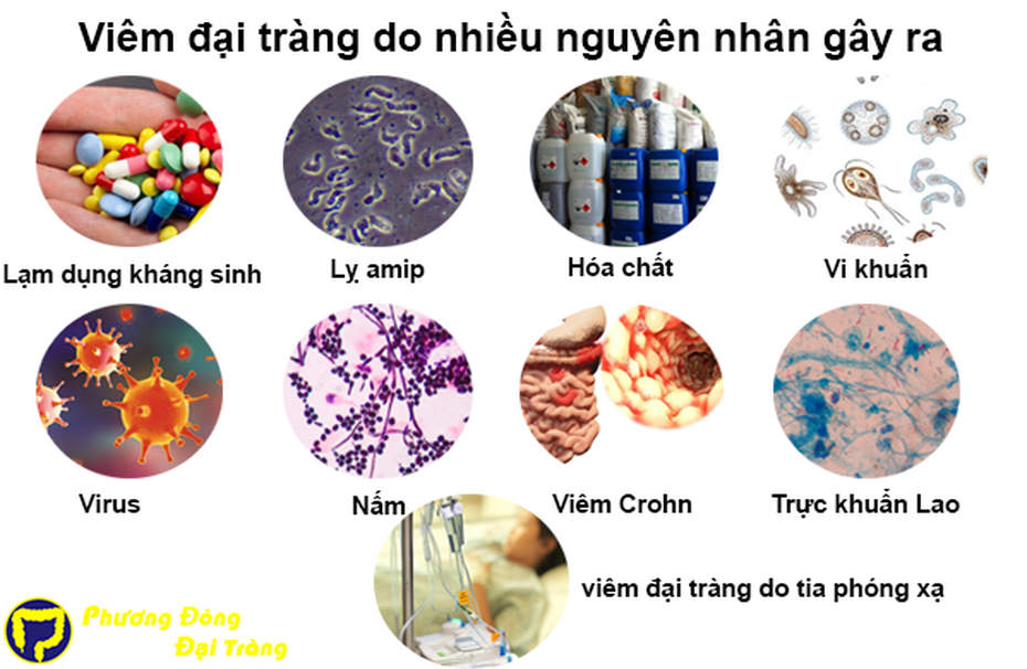 Bệnh viêm đại tràng có thể chữa khỏi được không?