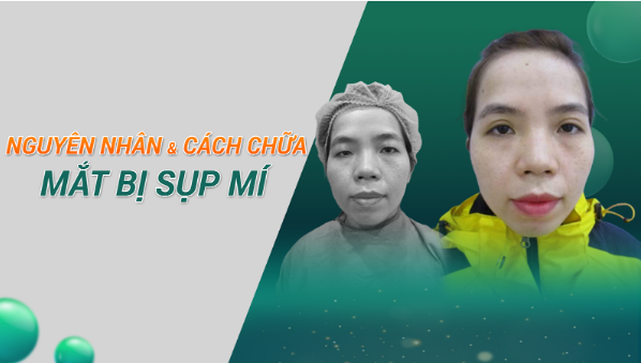 5 nguyên nhân sụp mí mắt và cách khắc phục cho đôi mắt khỏe đẹp