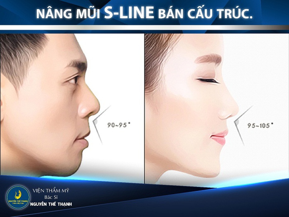 Mũi đẹp không lo biến chứng với nâng mũi S-Line bán cấu trúc