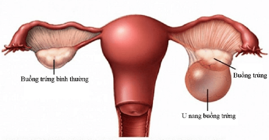 Giải đáp u nang buồng trứng kích thước bao nhiêu thì mổ?