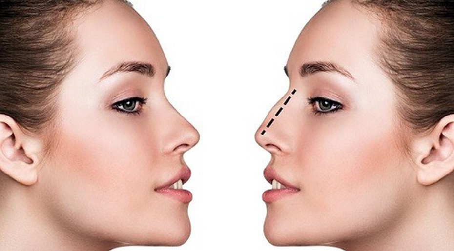 Có nên phẫu thuật thẩm mỹ không và lời giải trấn an dư luận