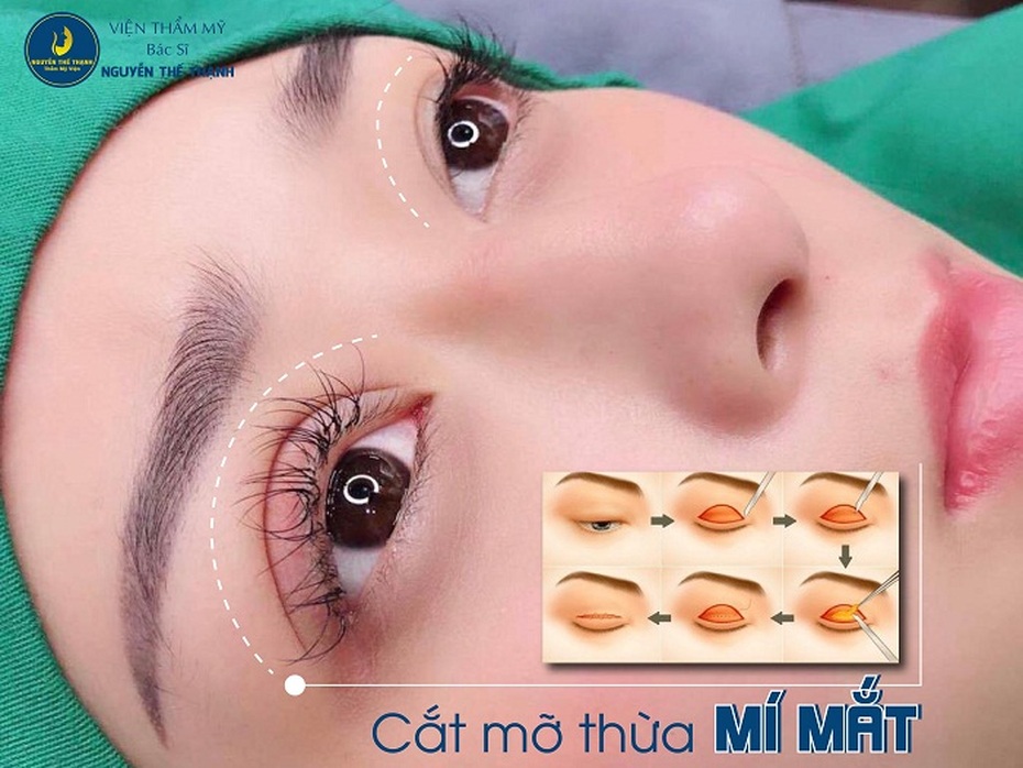 Địa chỉ lấy mỡ thừa mí mắt