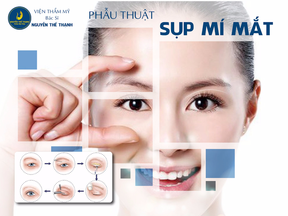 Phẫu thuật sụp mí mắt - Lấy lại đôi mắt hút hồn