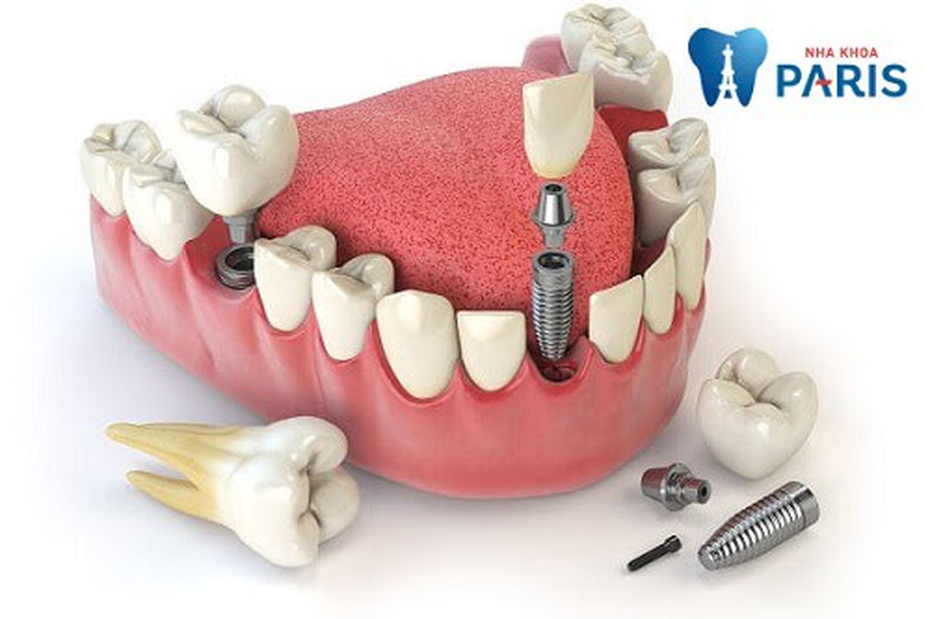 Trồng răng Implant loại nào tốt - 4 tips lựa chọn cực hay