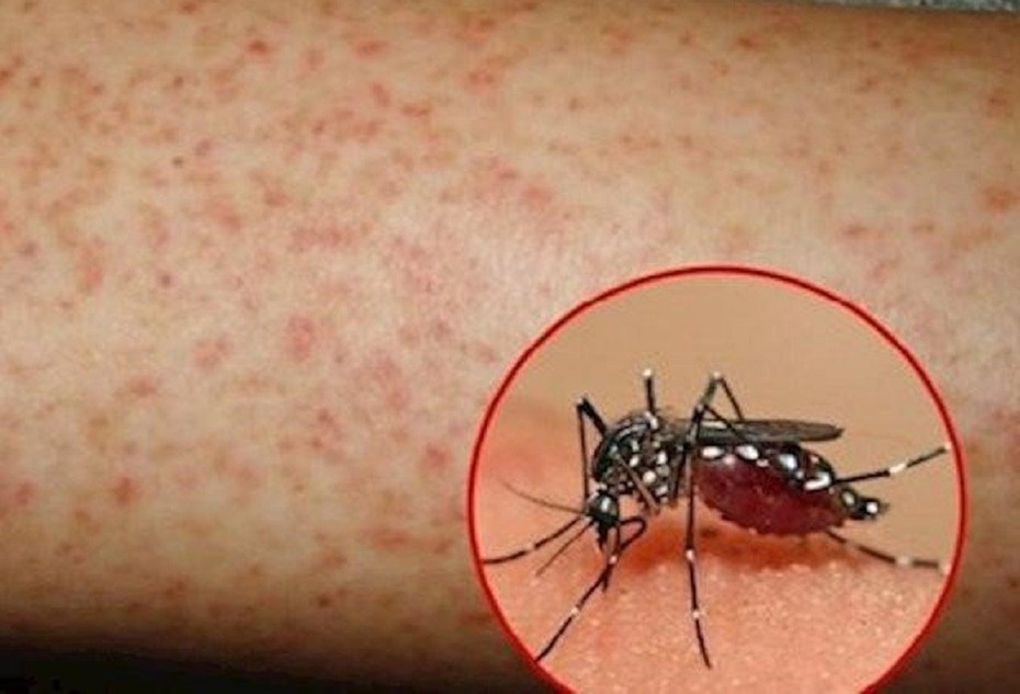 Ghi nhận một trường hợp trẻ tử vong do bệnh sốt xuất huyết Dengue