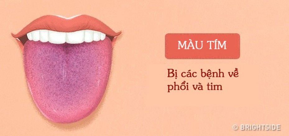 Màu sắc lưỡi tiết lộ các vấn đề sức khỏe