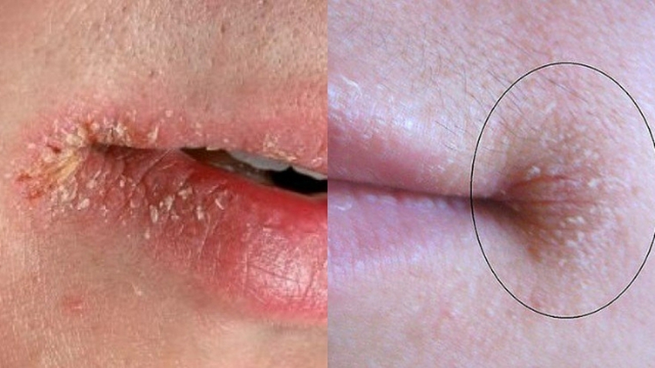 Không tham ăn mà vẫn bị chốc mép: Lời cảnh báo từ cơ thể