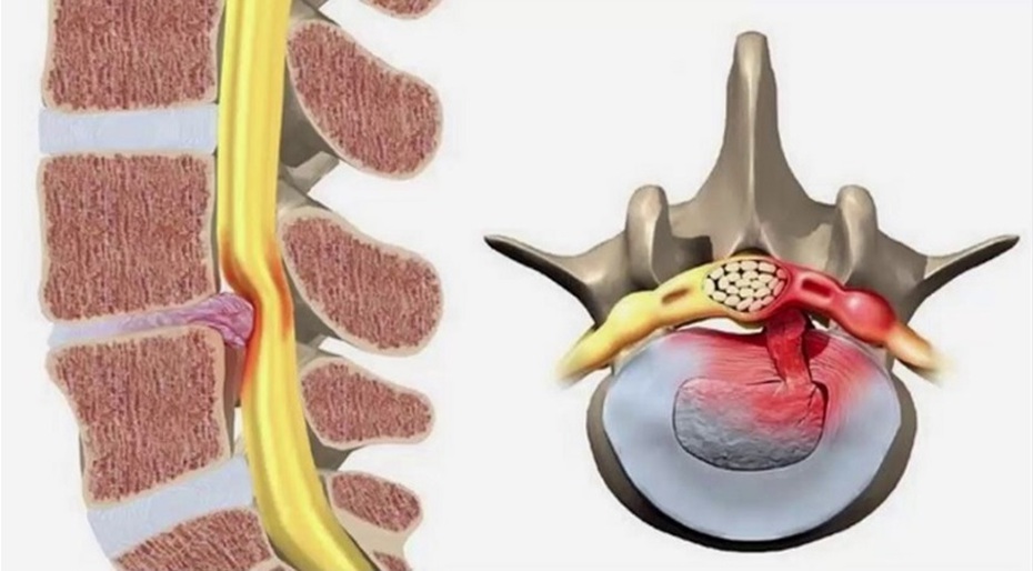 6 địa chỉ điều trị thoát vị đĩa đệm tại Hà Nội