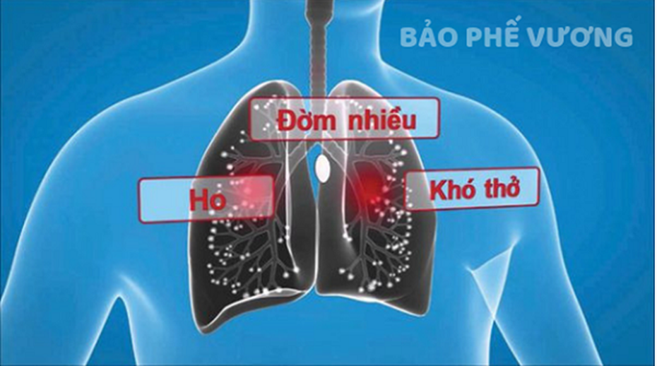 Ho, đờm kéo dài do viêm phế quản phải làm sao?