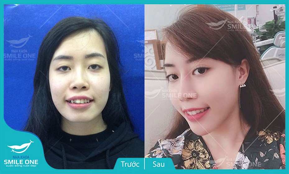 Hot girl Phương Giang và hành trình đứng lên từ vấp ngã bằng công nghệ niềng răng không đau
