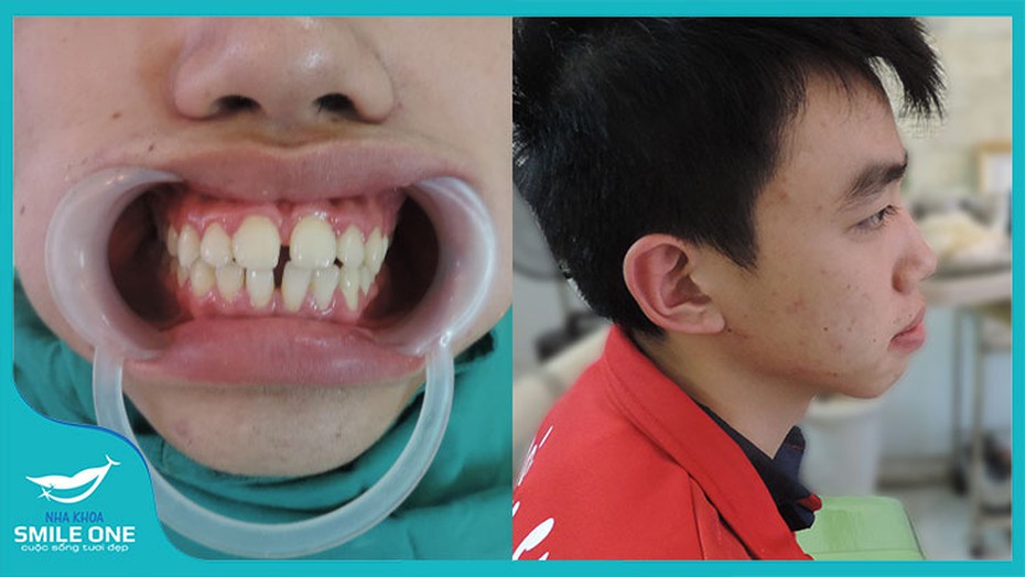 Chàng du học sinh Lào và những kỉ niệm khó quên khi niềng răng tại Nha khoa Smile One